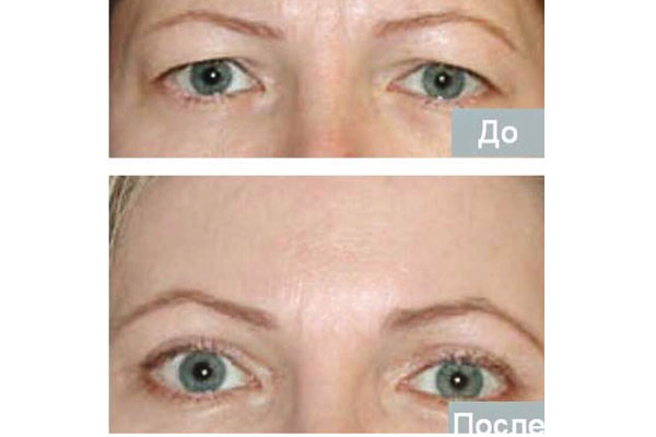 УЧЕНЫЕ РЯЗАНСКОГО МЕДИЦИНСКОГО УНИВЕРСИТЕТА ЗАПАТЕНТОВАЛИ УНИКАЛЬНЫЙ СПОСОБ ДОЛГОВЕЧНОГО ЛИФТИНГА ЛБА